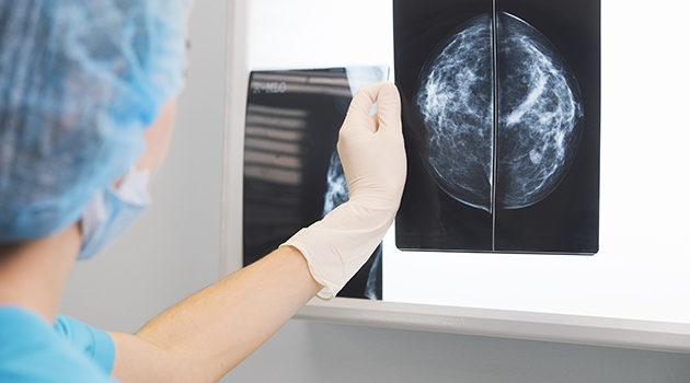 Bröstcancer upptäcks många gånger vid mammografiundersökningar.