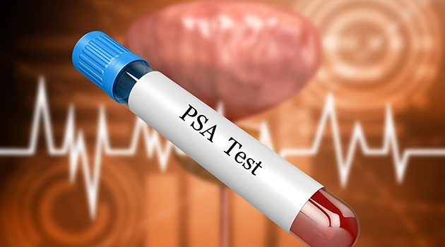 With the help of PSA tests, prostate cancer can be detected even before the disease gives symptoms, which increases the chances of a successful treatment.