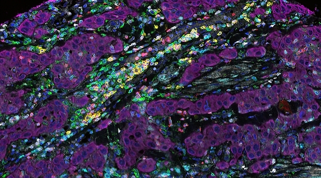 Mikroskopbild av mänsklig tumörvävnad (magentaröd) och olika immunceller (gröna, gula, vita, röda, kornblå). Den mörkare blå färgen visar alla cellers cellkärnor. 