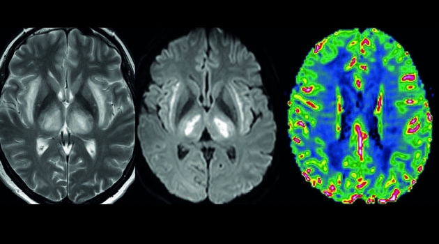 The images illustrate pathological findings on MRI examination of the brain of a patient suffering from covid19 with severe neurological symptoms.