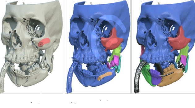 Med hjälp av den nya metoden kan man göra en CT-scanning av den skadade käken och sedan sätta ihop den trasiga käken som i ett 3D-pussel i datorn innan man utför den verkliga operationen.